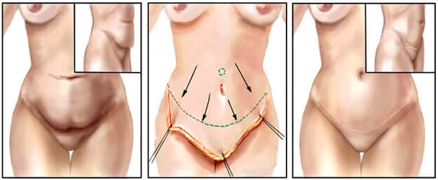abdominoplastia