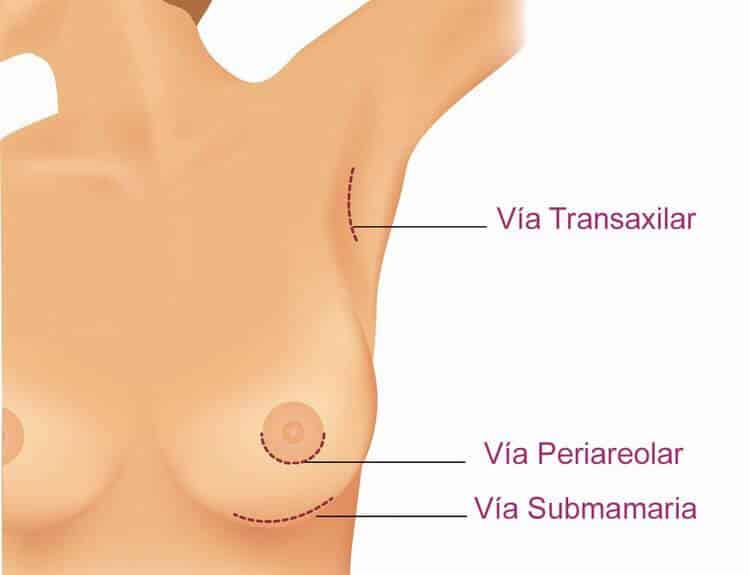 Técnicas del aumento pecho zaragoza: transaxilar, periareolar y submamaria