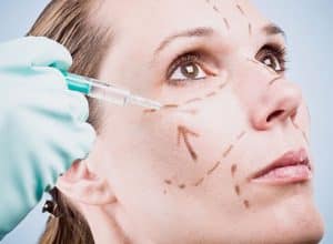 Mujer con marcaje para cirugía facial