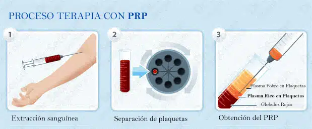 prp terapia PRP Capilar Alopecia